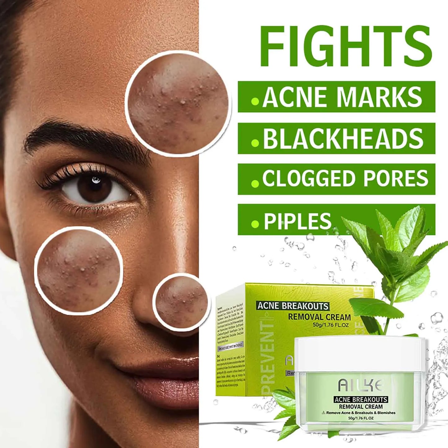 Acne Removal Face Cream
