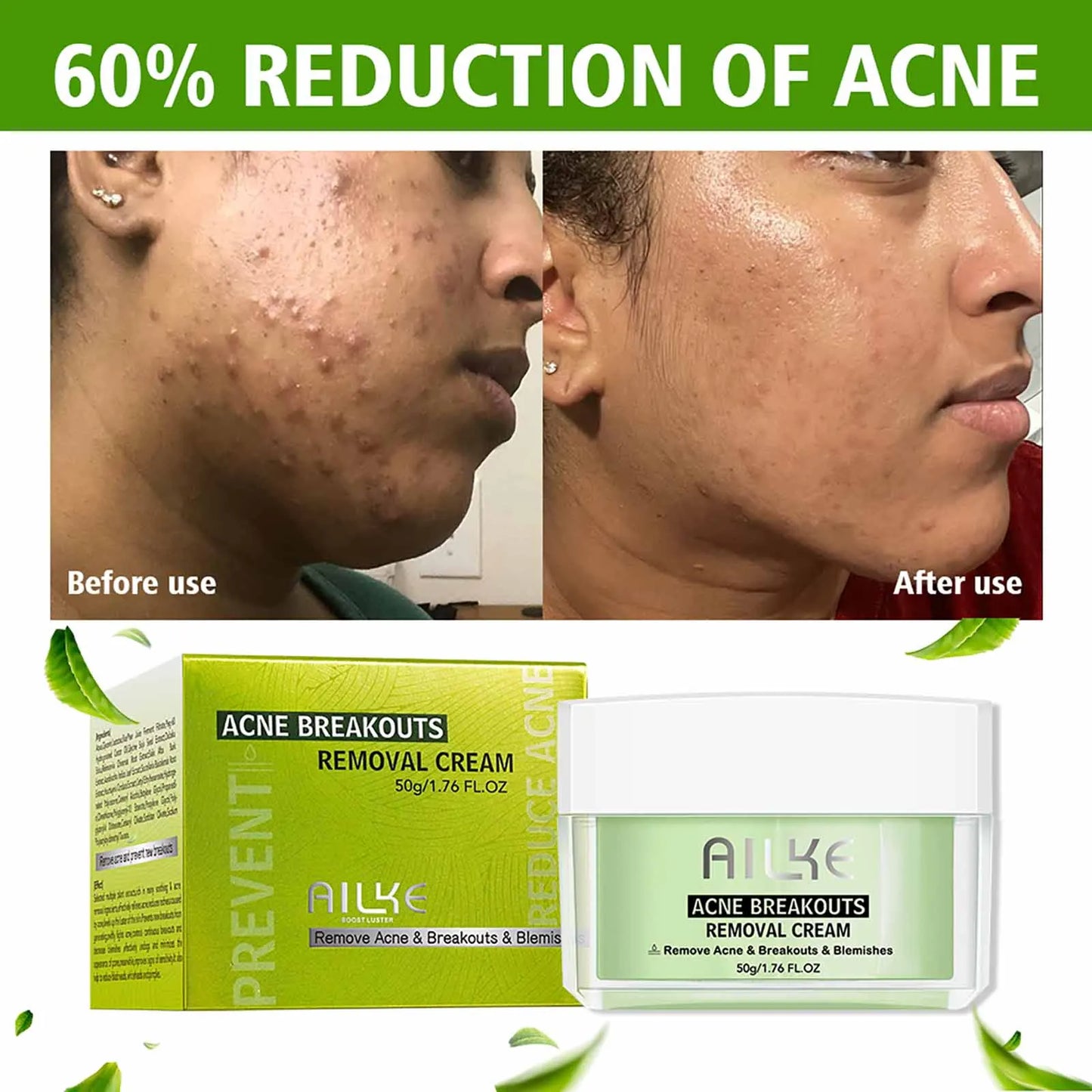 Acne Removal Face Cream