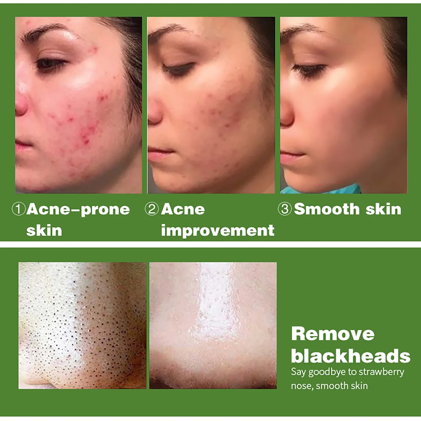 Acne Removal Face Serum