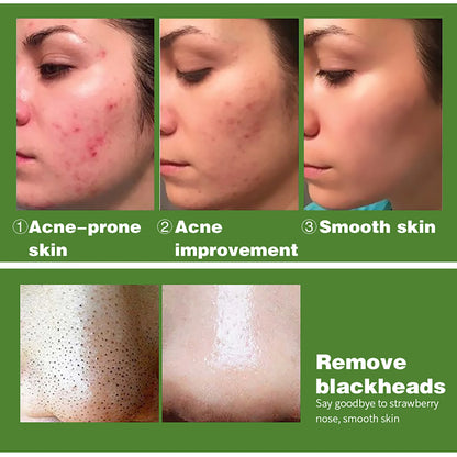 Acne Removal Face Serum