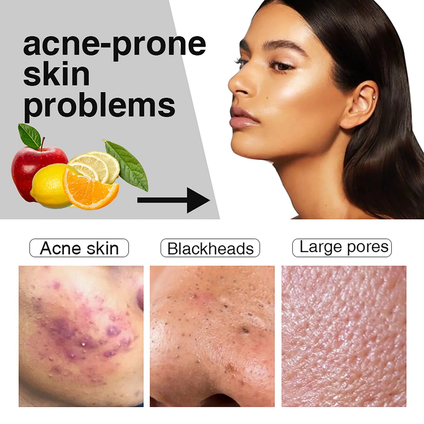Acne Removal Face Serum