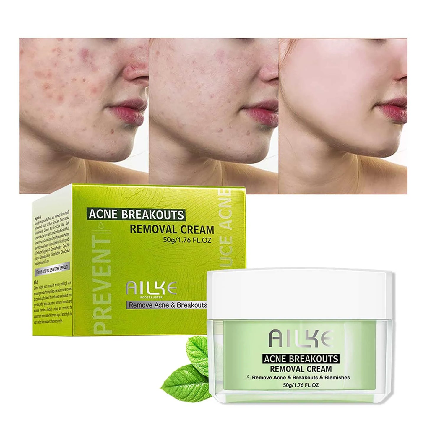 Acne Removal Face Cream